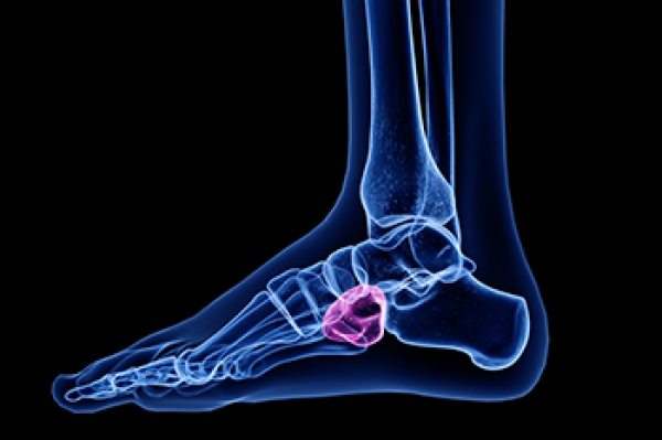 What Might Cause Pain in the Middle Outside Part of the Foot