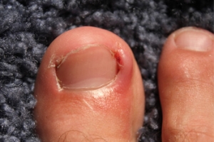 Do I Have an Ingrown Toenail?