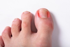 Types of Ingrown Toenails and How They Are Treated