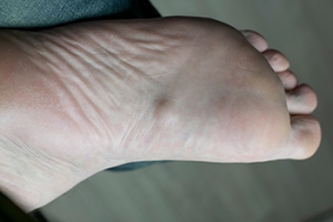 Plantar Fibromas and the Path to Comfortable Steps