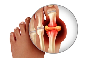 Treatment for Tophi Caused by Gout