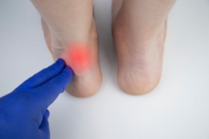 Managing Achilles Tendon Pain
