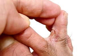 How Corns Develop