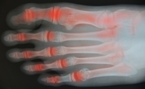How to Manage Foot Arthritis