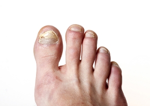 Noticeable Symptoms of a Toenail Fungus